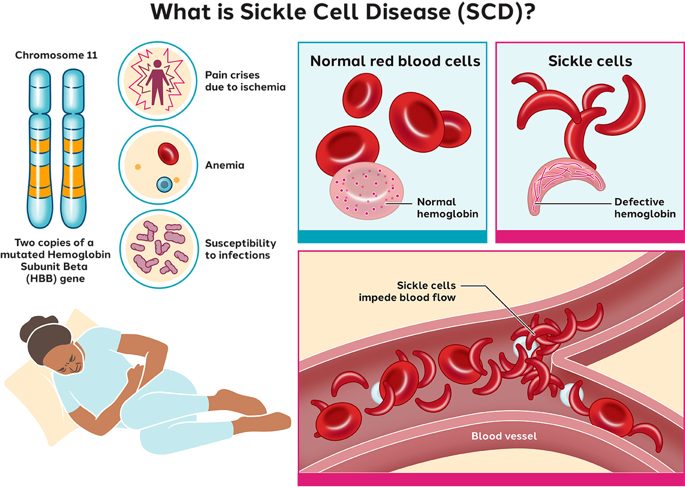Sickle Cell Disease Sangamo